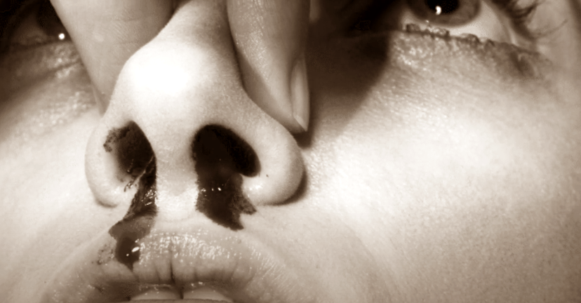 sangramento nasal
